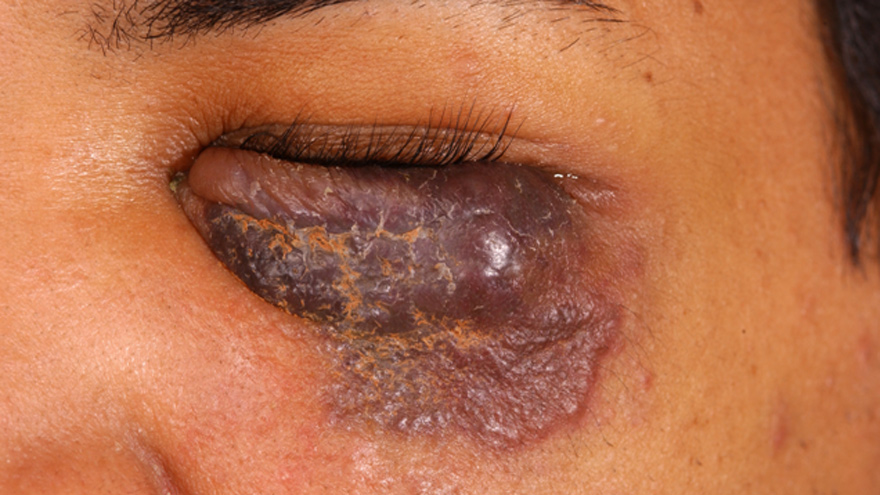 Kaposi’s sarcoma eyelid lesion