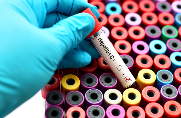 Hepatitis C blood test stock image